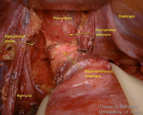  illuminated transhiatal retractor allows exposure of the distal thoracic esophagus during esophagectomy