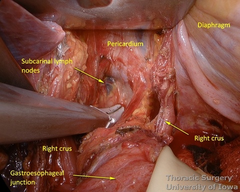  transhiatal retractor allows visualization of mediastinal lymph nodes during esophagectomy