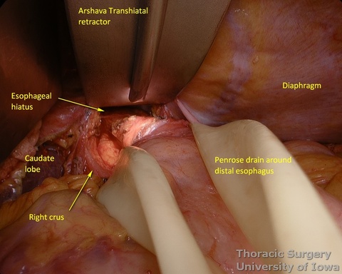 Arshava illuminated transhiatal retractor is used to facilitate exposure for mediastinal dissection esophagectomy