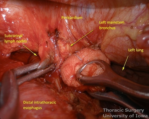Subcarinal lymph nodes resected under direct vision