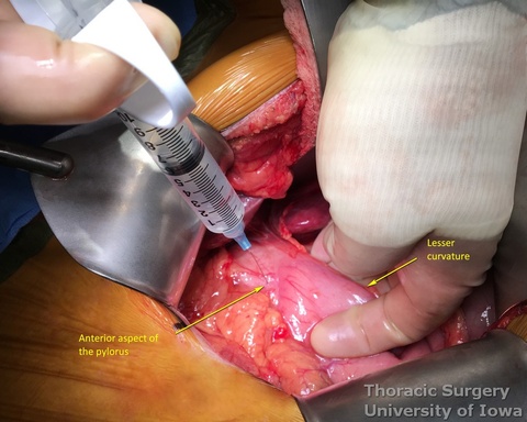 Botox injection into pylorus anteriorly during esophagectomy