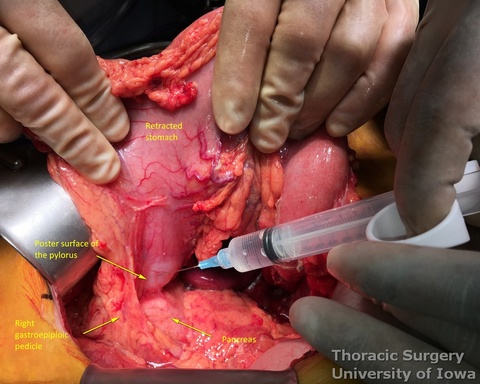 Botox injection into pylorus posteriorly during esophagectomy
