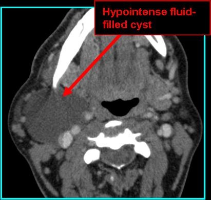 CT with Contrast CT1