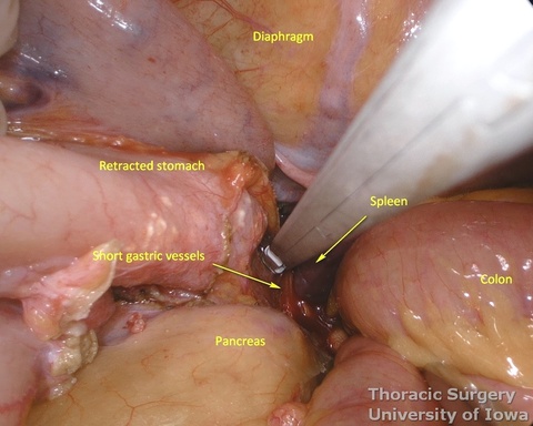 Care is taken not to injure spleen during highest short gastric vessels division at the time of gastric mobilization during esophagectomy