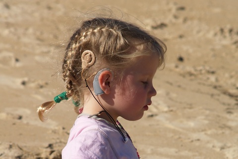 A Girl With a Cochlear Implant A Girl With a Cochlear Implant