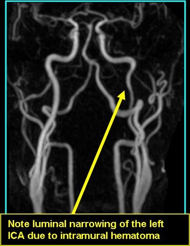 Dissection_MRA_0726.jpg Dissection_MRA_0726