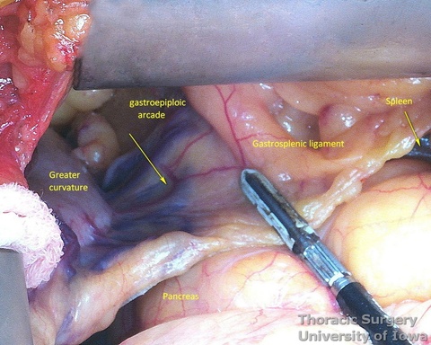 ivision of gastrocolic and gastrosplenic ligaments and preservation of the right gastroepiploic arcade 