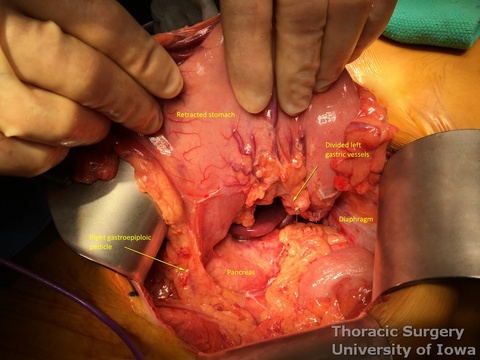 Division of left gastric vessels completes mobilization of the stomach during esophagectomy