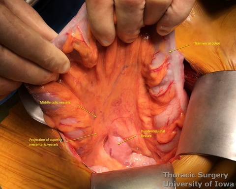 Duodenojejunal junction is identified retracting transverse mesocolon anteriorly and palpating spine