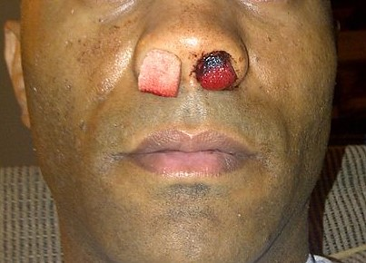 Epistaxis