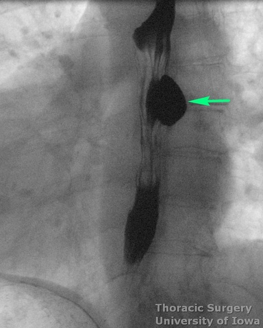 Esophageal diverticula midesophageal  and epiphrenic  esophagram demonstrating symptomatic diverticulum