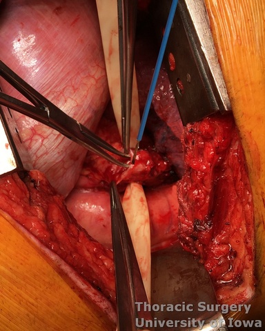 Esophageal diverticula midesophageal  and epiphrenic esophageal myotomy protecting  underlying mucosa