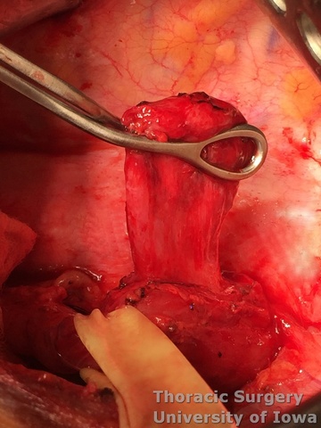 Esophageal diverticula midesophageal  and epiphrenic  symptomatic diverticulum pulsion diverticulum esophagus