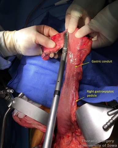 Esophagectomy 4 to 5 cm gastric tube is created assuring 5 cm margin distal to the tumor