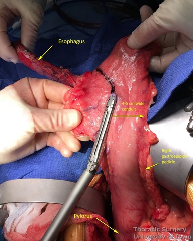Esophagectomy 4 to 5 cm gastric tube is created with serial applications of the linear cutting stapler