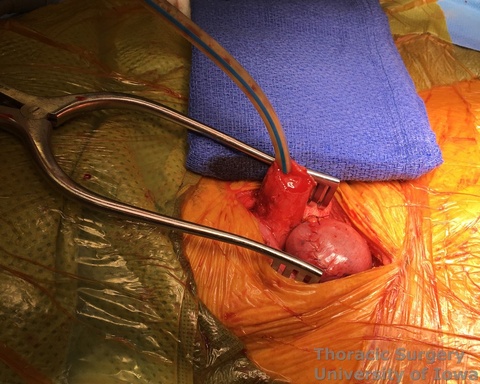 Esophagectomy cervical gastro esophageal anastomosis Staple line on the cervical esophagus is removed and NG advanced to help retract and align esophagus