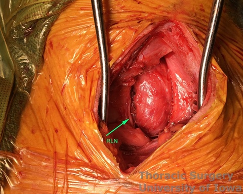 Esophagectomy for esophageal carcinoma cervical gastro esophageal anastomosis the supporting sponge is removed and anastomosis is allowed to retract behind manubrium