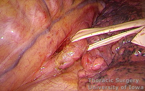 Esophagectomy for esophageal carcinoma thoracoscopic three incisions McKeown esophagus circumferentially dissected and encircled for retraction