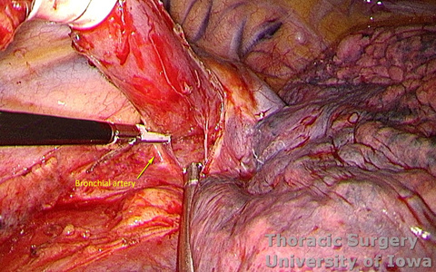 Esophagectomy for esophageal carcinoma thoracoscopic three incisions McKeown esophagus circumferentially dissected bronchial artery divided with energy device Ligasure