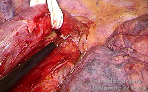 Esophagectomy for esophageal carcinoma thoracoscopic three-field McKeown esophagus dissected towards the  thoracic outlet after azygos vein divided with the stapler 