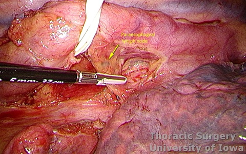 Esophagectomy for esophageal carcinoma thoracoscopic three incisions McKeown esophagus retracted  paraesophageal lymph resected as part of lymphadenectomy