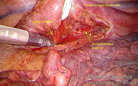 Esophagectomy for esophageal carcinoma thoracoscopic three incisions McKeown esophagus retracted paraesophageal lymphadenectomy lymphatic vessels clipped