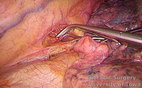 Esophagectomy for esophageal carcinoma thoracoscopic three incisions dissection between esophagus and descending thoracic aorta