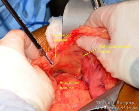 Esophagectomy for esophageal carcinoma transhiatal Gastrocolic ligament incised along the greater curvature with the right gastroepiploic vessels preserved