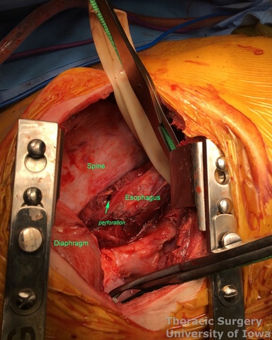 sophagectomy for perforated esophageal carcinoma thoracotomy  three incisions McKeown