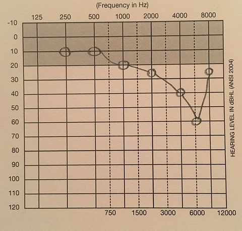 Example_of_Notched_Audiogram