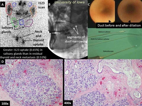 Figure%201%20radioiodine%20sialadenitis%20final%2001142013%20one%20slide%20with%20watermark%207%20am