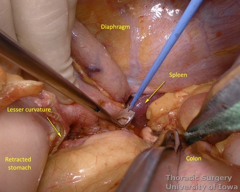 Fundus of the stomach is dissected completely free to the esophageal hiatus dividing gastro-phenic ligament and remaining adhesions