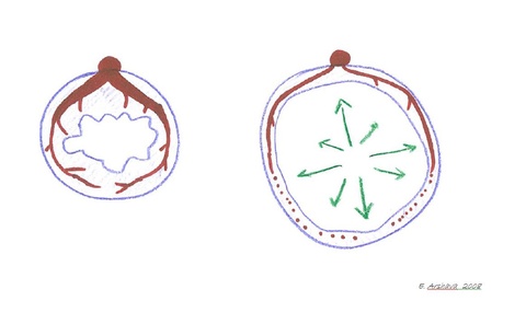 Gastric conduit distention after esophagectomy may lead to ischemia and increase risk of an anastomotic leak