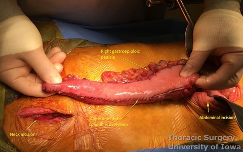 esophagectomy_Gastric conduit is oversewn with seromuscular running sutures that are tied in the middle of the staple line