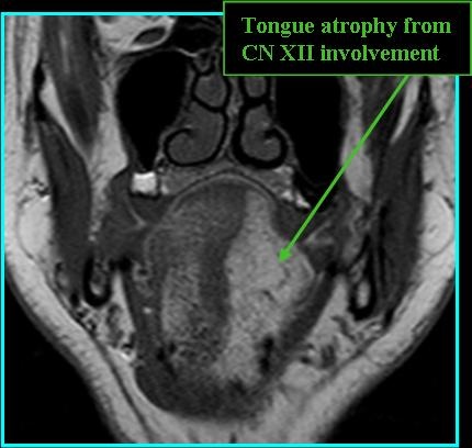 JagPara_T2tongue_0720