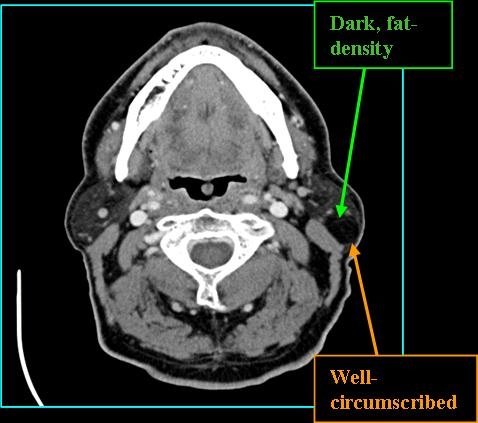 LIPOMA_CT_0713