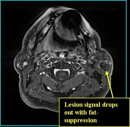 LIPOMA_T1POST_0713