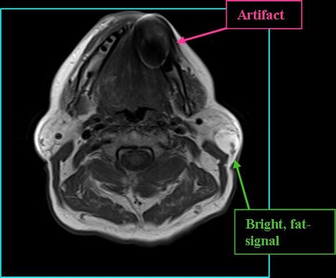 LIPOMA_T1_0713