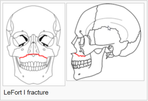 Le%20Fort%20fracture%20of%20skull%20-%20Wikipedia,%20the%20free%20encyclopedia_2014-07-22_16-56-35.png Le%20Fort%20fracture%20of%20skull%20-%20Wikipedia,%20the%20free%20encyclopedia_2014-07-22_16-56-35