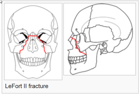 Le%20Fort%20fracture%20of%20skull%20-%20Wikipedia,%20the%20free%20encyclopedia_2014-07-22_16-57-02.png Le%20Fort%20fracture%20of%20skull%20-%20Wikipedia,%20the%20free%20encyclopedia_2014-07-22_16-57-02