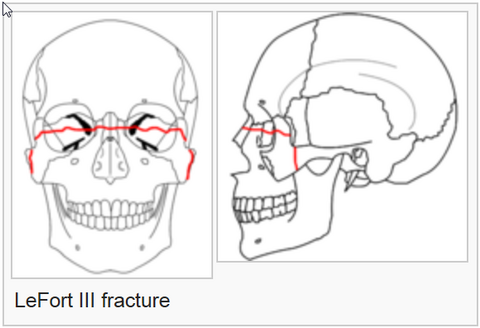 Le%20Fort%20fracture%20of%20skull%20-%20Wikipedia,%20the%20free%20encyclopedia_2014-07-22_16-57-19.png Le%20Fort%20fracture%20of%20skull%20-%20Wikipedia,%20the%20free%20encyclopedia_2014-07-22_16-57-19