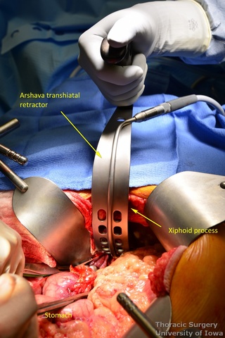 Lighted transhiatal retractor is introduced into the posterior mediastinum through the esophageal hiatus