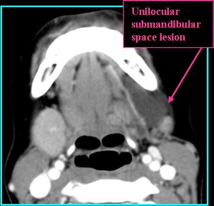 LymphMal_CT_0716