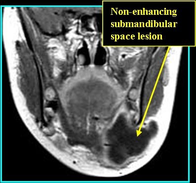 LymphMal_T1post_0716