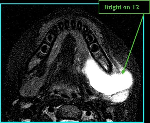 LymphMal_T2_0719