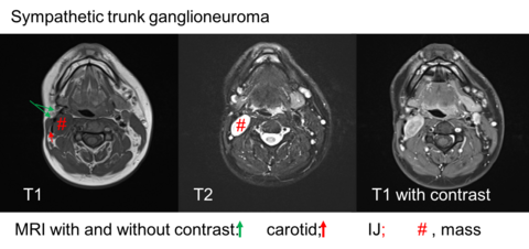 MRI