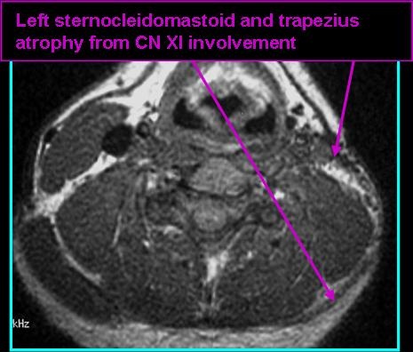 MeningJug_T1atrophy_0720