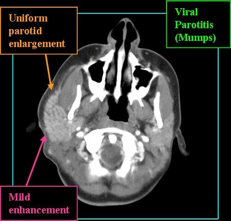 PAROTITIS_CT_0713
