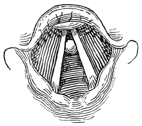 PSM_V64_D274_Vocal_cord_tumor_interfering_with_voice_production