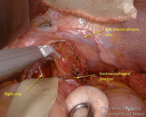 Phrenoesophageal ligament and postradiation adhesions are divided to enter the mediastinum